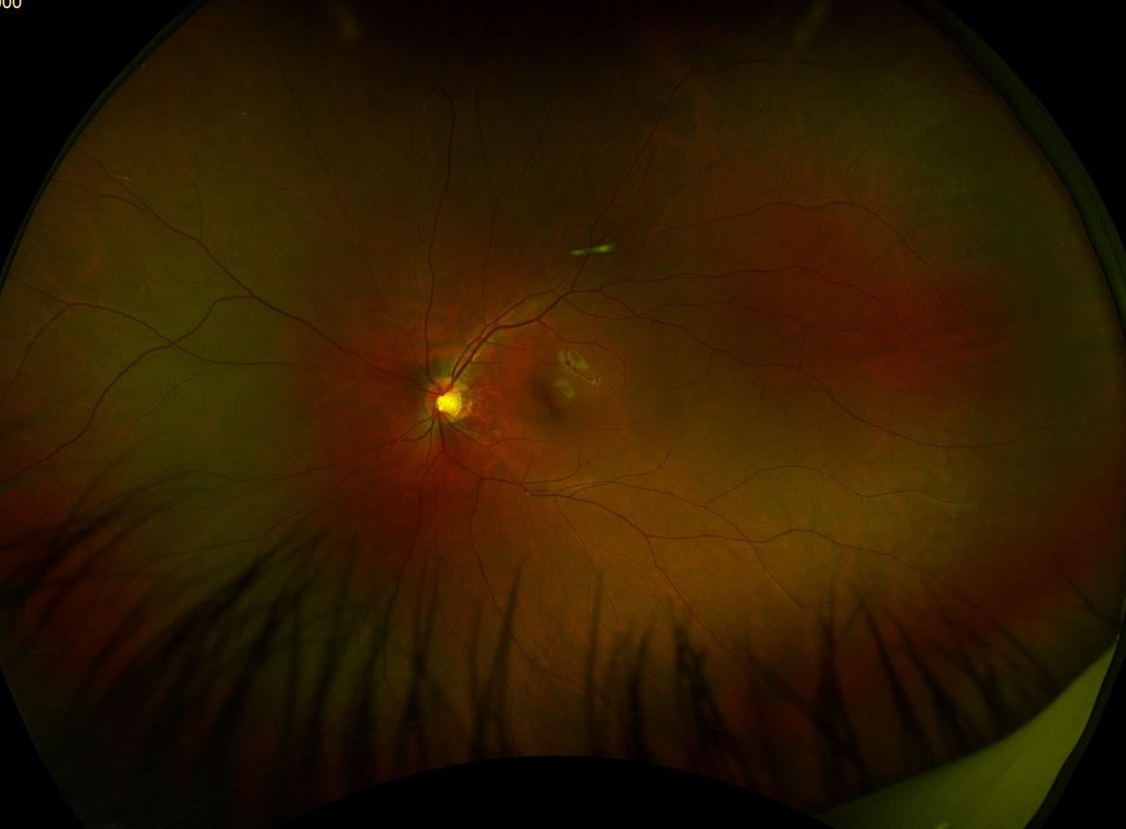 Wide-field retinal photograph showing the optic nerve head and retinal blood vessels