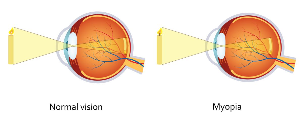 Illustration comparing normal vision and myopia, showing how light focuses differently on the retina in each condition.