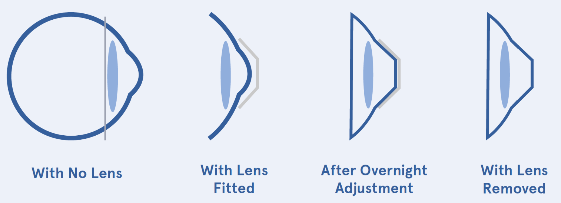 Diagram showing the progressive effect of orthokeratology: from a natural eye shape with no lens, to fitting an Ortho-K lens, followed by overnight corneal reshaping, and finally clear vision during the day with the lens removed.