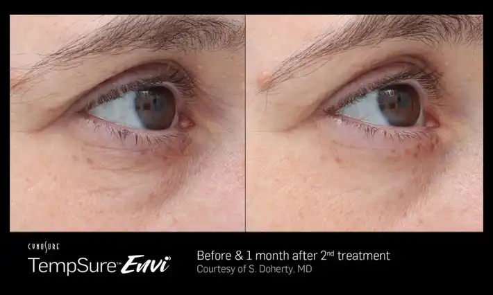 TempSure Envi Results